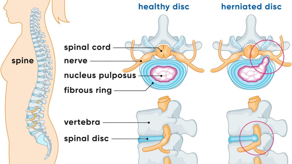 disc-herniation-slipped-disc illustration 1
