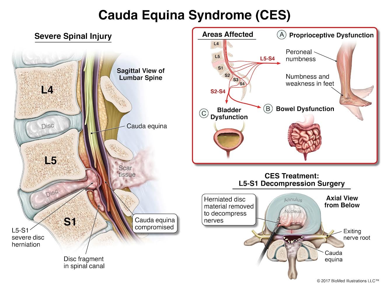 sciatica illustration 1