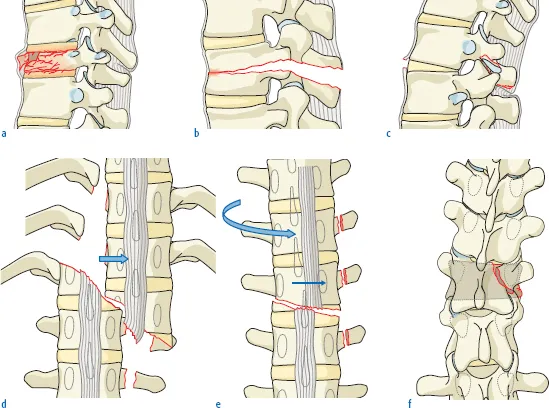 spinal-fractures-and-trauma illustration 1