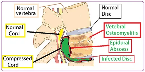 spinal-infection illustration 1